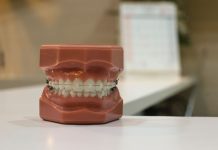 What You Need to Know About Your Wisdom Teeth